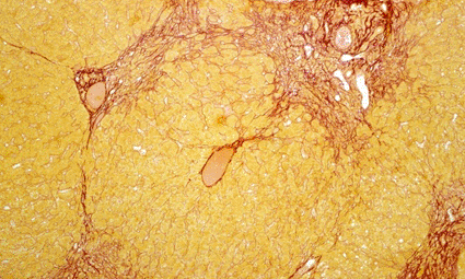 Image: Light micrograph of a section through a liver affected by the Hepatitis C virus (Photo courtesy of PR J. L. Kemeny, ISM / SPL).